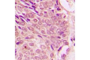 Immunohistochemical analysis of STAT1 (pS727) staining in human breast cancer formalin fixed paraffin embedded tissue section.