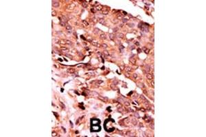 Formalin-fixed and paraffin-embedded human cancer tissue reacted with the primary antibody, which was peroxidase-conjugated to the secondary antibody, followed by AEC staining. (Caspase 6 Antikörper  (pSer257))