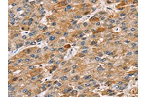 The image on the left is immunohistochemistry of paraffin-embedded Human liver cancer tissue using ABIN7131211(STARD8 Antibody) at dilution 1/30, on the right is treated with fusion protein. (STARD8 Antikörper)