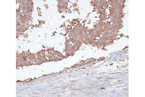 Immunohistochemistry of paraffin-embedded Human mammary cancer using TGFBR2 Polyclonal Antibody at dilution of 1:100 (40x lens). (TGFBR2 Antikörper)
