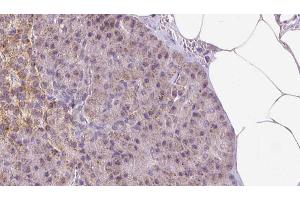 ABIN6273293 at 1/100 staining Human pancreas cancer tissue by IHC-P.