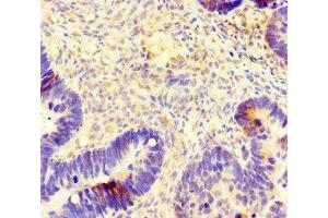 Immunohistochemistry of paraffin-embedded human ovarian cancer using ABIN7173691 at dilution of 1:100 (TUBB4 Antikörper  (AA 1-444))