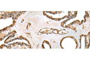 Immunohistochemistry of paraffin-embedded Human thyroid cancer tissue using SFN Polyclonal Antibody at dilution of 1:25(x200) (14-3-3 sigma/SFN Antikörper)