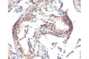 IHC testing of FFPE human testicular carcinoma with TGF alpha antibody (TGFA Antikörper  (C-Term))