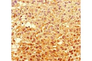 Immunohistochemistry of paraffin-embedded human melanoma using ABIN7154056 at dilution of 1:100 (GCDH Antikörper  (AA 45-300))