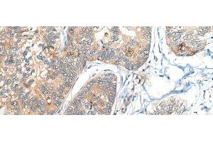 Immunohistochemistry of paraffin-embedded Human gastric cancer tissue using BCAN Polyclonal Antibody at dilution of 1:35(x200) (BCAN Antikörper)