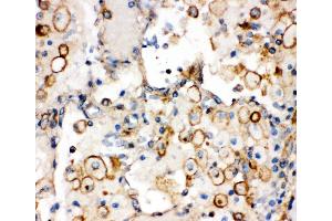 Anti-Integrin alpha 1 antibody,  IHC(P) IHC(P): Human Lung Cancer Tissue