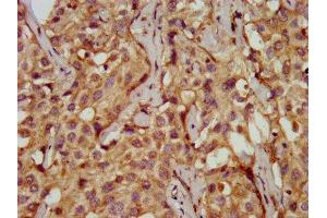 IHC image of ABIN7149571 diluted at 1:200 and staining in paraffin-embedded human liver cancer performed on a Leica BondTM system. (PDSS2 Antikörper  (AA 292-387))
