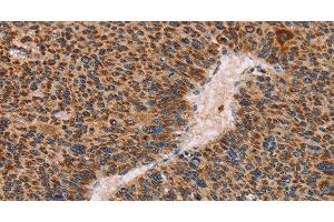 Immunohistochemistry of paraffin-embedded Human liver cancer using MMP1 Polyclonal Antibody at dilution of 1:60 (MMP1 Antikörper)