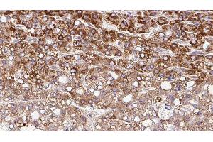 ABIN6279842 at 1/100 staining Human liver cancer tissue by IHC-P. (SLC10A4 Antikörper  (C-Term))
