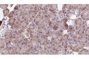 ABIN6273272 at 1/100 staining Human pancreas cancer tissue by IHC-P. (NCKAP1 Antikörper  (Internal Region))
