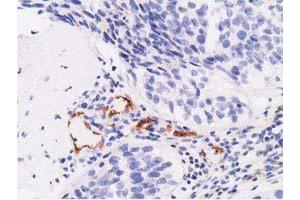 Immunohistochemical staining of paraffin-embedded Carcinoma of Human bladder tissue using anti-AFP mouse monoclonal antibody. (alpha Fetoprotein Antikörper)