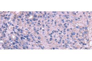 Immunohistochemistry of paraffin-embedded Human breast cancer using TRIM14 Polyclonal Antibody at dilution of 1/35 (TRIM14 Antikörper)