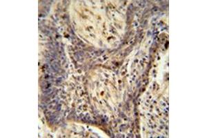 Formalin fixed and paraffin embedded human lung carcinoma reacted with PPRC1 Antibody (C-term) followed by peroxidase conjugation of the secondary antibody and DAB staining. (PPRC1 Antikörper  (C-Term))