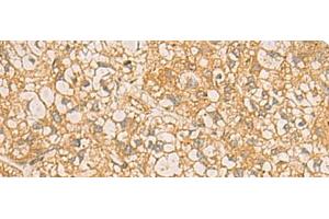Immunohistochemistry of paraffin-embedded Human liver cancer tissue using FAAP100 Polyclonal Antibody at dilution of 1:50(x200) (C17orf70 Antikörper)
