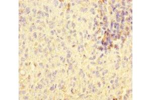 Immunohistochemistry of paraffin-embedded human melanoma using ABIN7170802 at dilution of 1:100 (STOML2 Antikörper  (AA 29-356))