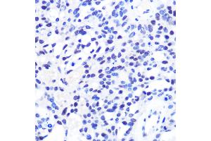 Immunohistochemistry of paraffin-embedded Human oophoroma using CHD4 antibody (ABIN6127308, ABIN6138512, ABIN6138513 and ABIN6215263) at dilution of 1:100 (40x lens). (CHD4 Antikörper  (AA 1520-1690))