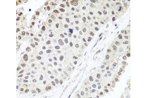 Immunohistochemistry of paraffin-embedded Human lung cancer using ALKBH4 Polyclonal Antibody at dilution of 1:100 (40x lens). (ALKBH4 Antikörper)
