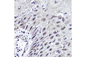 Immunohistochemistry of paraffin-embedded human esophageal cancer using CUX1 antibody (ABIN1679438, ABIN3015866, ABIN3015867 and ABIN6219446) at dilution of 1:200 (40x lens). (CUX1 Antikörper  (AA 1-280))