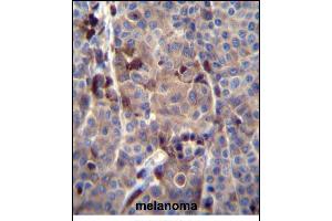 PREF8 Antibody (C-term) (ABIN656145 and ABIN2845481) immunohistochemistry analysis in formalin fixed and paraffin embedded human melanoma tissue followed by peroxidase conjugation of the secondary antibody and DAB staining. (PRAMEF8 Antikörper  (C-Term))
