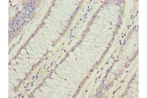 Immunohistochemistry of paraffin-embedded human colon cancer using ABIN7165562 at dilution of 1:100 (FAM78A Antikörper  (AA 21-283))