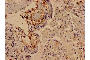 Immunocytochemistry analysis of human lung cancer using ABIN7169803 at dilution of 1:100 (SLITRK5 Antikörper  (AA 617-890))