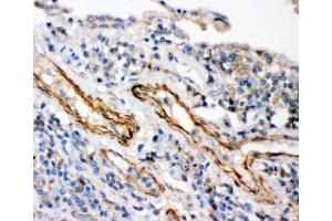 IHC-P: IKKb antibody testing of human lung cancer tissue