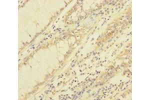 Immunohistochemistry of paraffin-embedded human colon cancer using ABIN7172031 at dilution of 1:100 (TXNL1 Antikörper  (AA 2-289))
