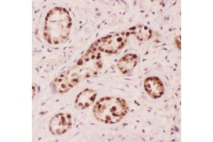 Anti-APE1 Picoband antibody,  IHC(P): Human Lung Cancer Tissue (APEX1 Antikörper  (AA 2-318))