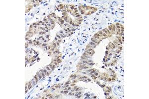 Immunohistochemistry of paraffin-embedded human colon carcinoma using SNRPF Rabbit pAb (ABIN6132678, ABIN6148228, ABIN6148229 and ABIN6215753) at dilution of 1:200 (40x lens). (SNRPF Antikörper  (AA 1-86))