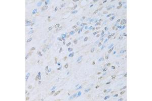 Immunohistochemistry of paraffin-embedded human liver cancer using KAT2A antibody. (KAT2A Antikörper)