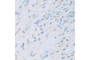 Immunohistochemistry of paraffin-embedded human liver cancer using KAT2A antibody.