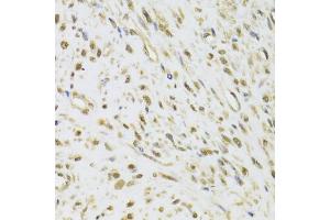 Immunohistochemistry of paraffin-embedded human leiomyoma of uterus using DDX1 Antibody (ABIN5973950) at dilution of 1/100 (40x lens). (DDX1 Antikörper)