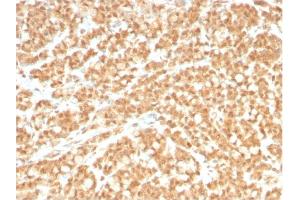 Formalin-fixed, paraffin-embedded human Colon Carcinoma stained with ICOSL-Monospecific Mouse Monoclonal Antibody (ICOSL/3260). (ICOSLG Antikörper  (AA 23-149))