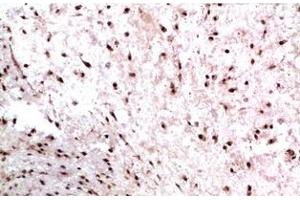 Immunohistochemistry of paraffin-embedded Human colon carcinoma tissue using CBX3 Monoclonal Antibody at dilution of 1:200. (CBX3 Antikörper)