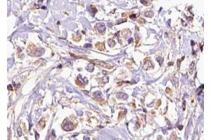 ABIN6276874 at 1/100 staining Human breast cancer tissue by IHC-P. (HMBS Antikörper  (Internal Region))