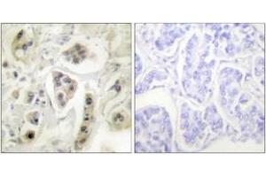 Immunohistochemistry analysis of paraffin-embedded human lung carcinoma tissue, using HSP60 Antibody.