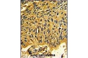 Formalin-fixed and paraffin-embedded human lung carcinoma reacted with CDK2 Antibody (C-term), which was peroxidase-conjugated to the secondary antibody, followed by DAB staining. (CDK2 Antikörper  (C-Term))