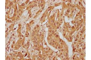 IHC image of ABIN7140235 diluted at 1:300 and staining in paraffin-embedded human liver cancer performed on a Leica BondTM system. (WFIKKN1 Antikörper  (AA 187-207))