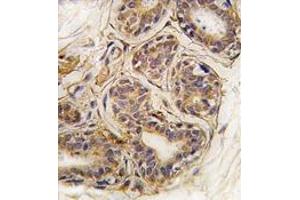 Formalin-fixed and paraffin-embedded human breast carcinoma tissue reacted with CASC3 Antibody , which was peroxidase-conjugated to the secondary antibody, followed by DAB staining.