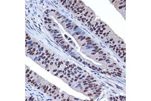 Immunohistochemistry of paraffin-embedded human colon carcinoma using WDR4 Rabbit mAb (ABIN7271355) at dilution of 1:100 (40x lens). (WDR4 Antikörper)
