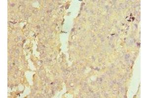 Immunohistochemistry of paraffin-embedded human colon cancer using ABIN7160732 at dilution of 1:100 (PTPDC1 Antikörper  (AA 161-235))