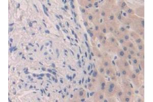 Detection of FGF19 in Human Liver cancer Tissue using Polyclonal Antibody to Fibroblast Growth Factor 19 (FGF19) (FGF19 Antikörper  (AA 4-216))