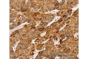 Immunohistochemistry of Human liver cancer using LTB Polyclonal Antibody at dilution of 1:45 (LTB Antikörper)
