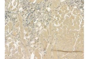ABIN6264824 and ABIN6276917 at 1/100 staining human tongue carcinoma by IHC-P. (RPGR Antikörper  (C-Term))