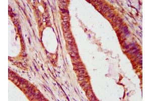 IHC image of ABIN7156667 diluted at 1:600 and staining in paraffin-embedded human colon cancer performed on a Leica BondTM system. (IFIT2 Antikörper  (AA 130-265))