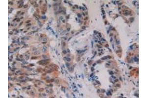 Detection of PKD1 in Human Breast Cancer Tissue using Polyclonal Antibody to Protein Kinase D1 (PKD1) (PKC mu Antikörper)