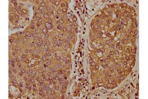 IHC image of ABIN7171357 diluted at 1:400 and staining in paraffin-embedded human liver cancer performed on a Leica BondTM system. (TCL1B Antikörper  (AA 1-128))