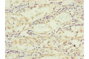 Immunohistochemistry of paraffin-embedded human gastric cancer using ABIN7159902 at dilution of 1:100 (TIMM17B Antikörper  (AA 1-172))