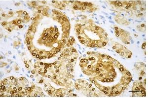 Immunohistochemistry was performed on paraffin-embedded human prostatic adenocarcinoma using spermine synthase antibody (ABIN7800420), 1:200).
